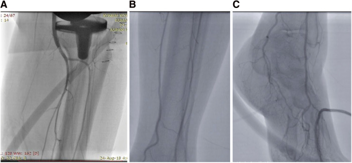 Endovascular Therapy as an Emerging Paradigm for the Treatment of Popliteal Artery Thrombosis Following Total Knee Arthroplasty: A New Approach to Acute Limb Ischemia Management.