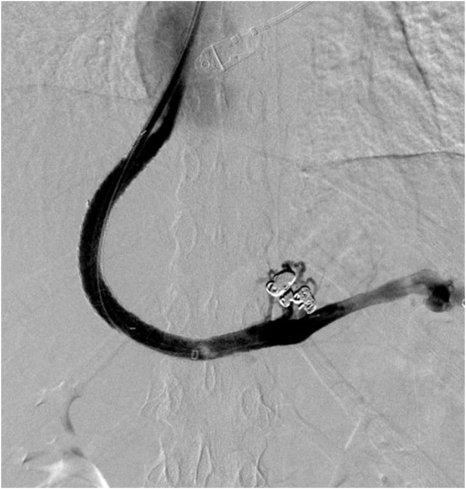 Portal Vein Recanalization Transjugular Intrahepatic Portosystemic Shunt for Noncirrhotic Chronic Portal Vein Thrombosis Leading to Successful Pregnancy: Case Report
