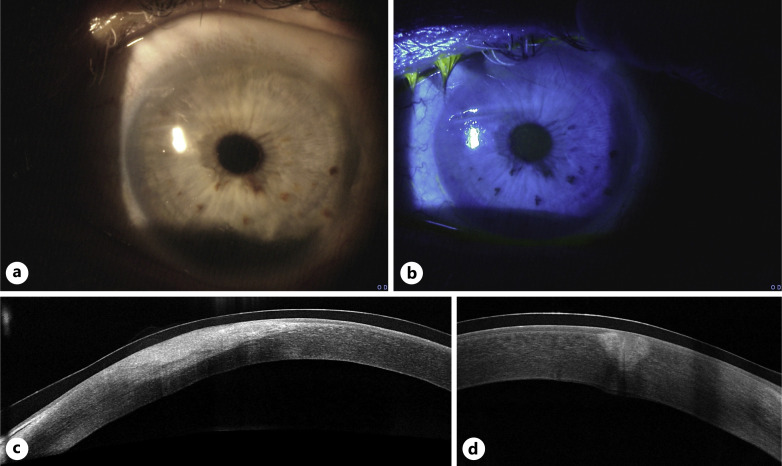Management of Diathermy-Induced Corneal Burn following Upper Eyelid Blepharoplasty with Multilayer Amniotic Membrane Transplantation: A Case Report and Review of the Literature.