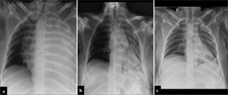 Trocar Catheter: A New Alternative for Point of Care for Management of Pleural Effusion by Palliative Care Physicians.