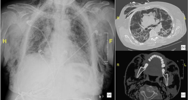 Subcutaneous Emphysema and Severe Interstitial Lung Disease in the Setting of Anti-MDA 5 Positive Dermatomyositis in a Hispanic Patient.