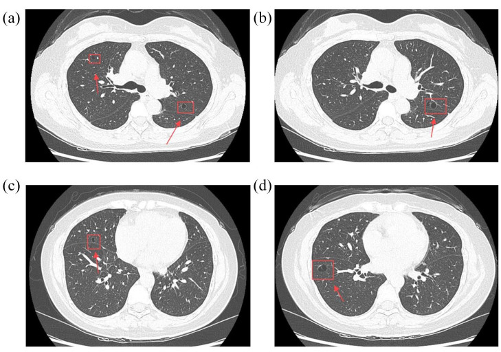 Tracheobronchial amyloidosis with Sjögren's syndrome: a case report.