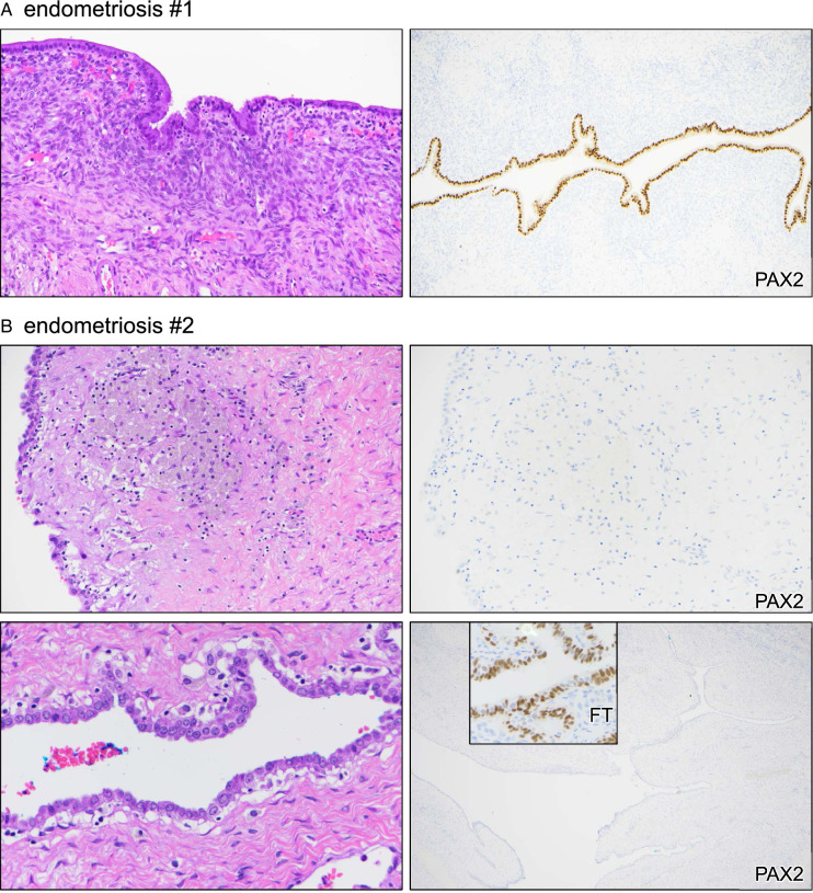 β-catenin, PAX2, and PTEN Aberrancy Across the Spectrum of Endometrioid Ovarian Lesions.