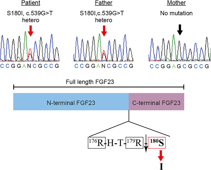A Novel Pathogenic Variant in Fibroblast Growth Factor 23 outside the Furin-Recognizing RXXR Motif in an Autosomal Dominant Hypophosphatemic Rickets Patient.