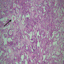 Intraoral Pleomorphic Adenoma of the Minor Salivary Glands: A Case Series of 10 Cases With Emphasis on Histopathological Features.