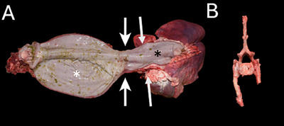 Segmental Megaesophagus Secondary to Extraluminal Esophageal Stenosis Caused by Transitional Seventh Cervical Vertebra and Supernumerary Ribs in a Goat.
