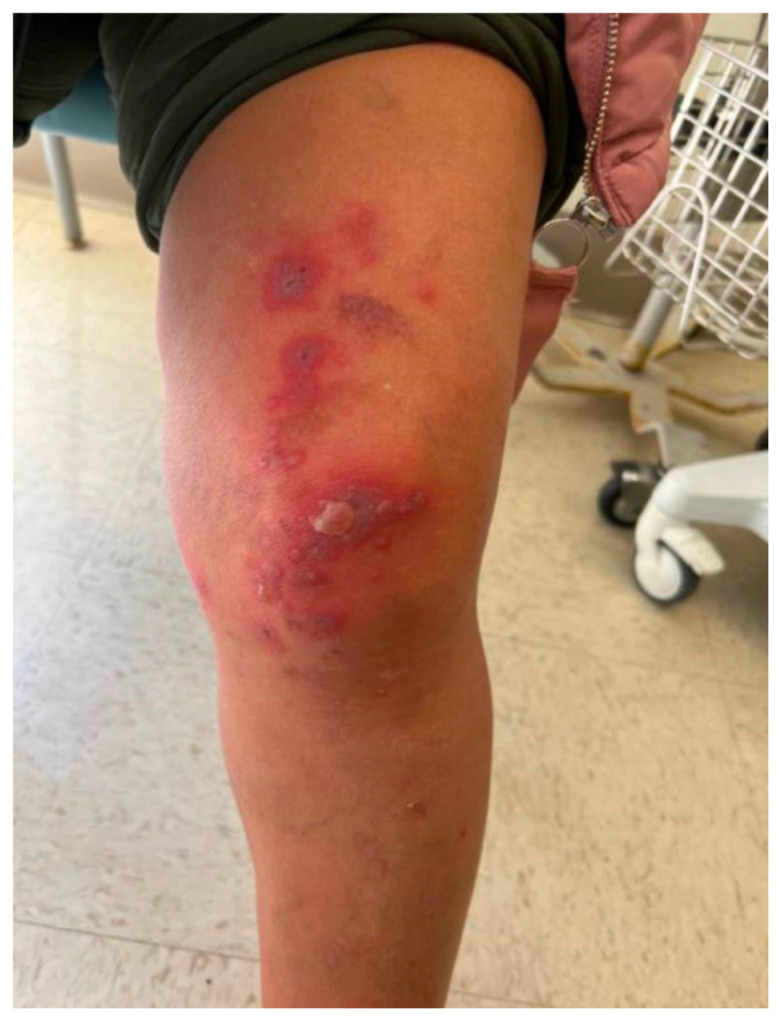 A Case Report on an Elusive Incident of Erythema Multiforme.