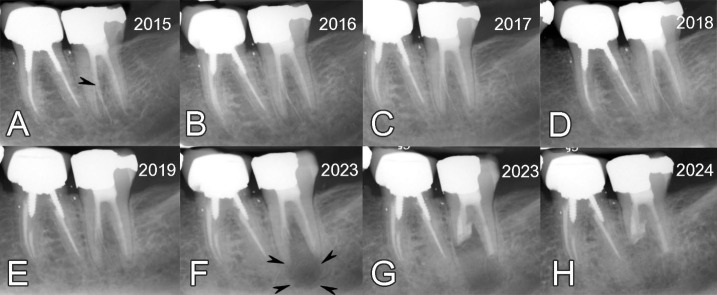 Management of a Late Complication of Strip Perforation with Overextended Gutta-percha Using Intentional Replantation: A 10-Year Follow-up Case Report.