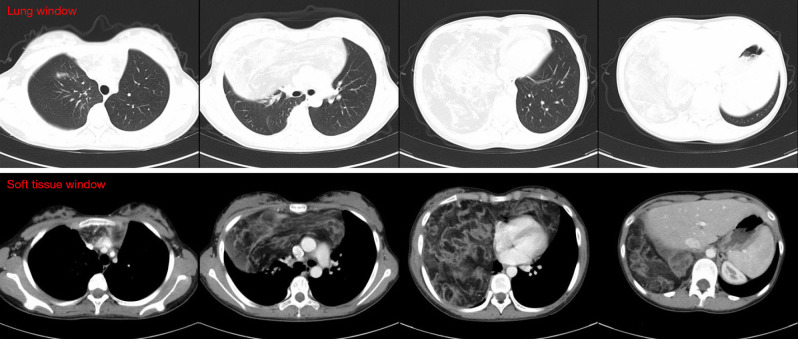 Giant thymolipoma in a 16-year-old girl with multimodal diagnostic approach and surgical management: a case report.