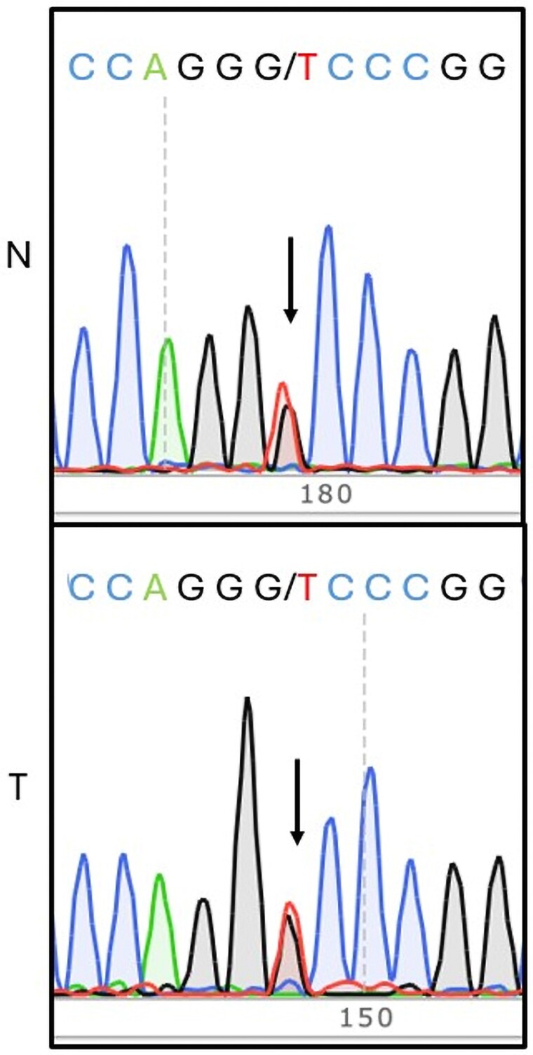 <i>FLCN</i> Variants in Parathyroid Carcinoma and Atypical Parathyroid Tumors.