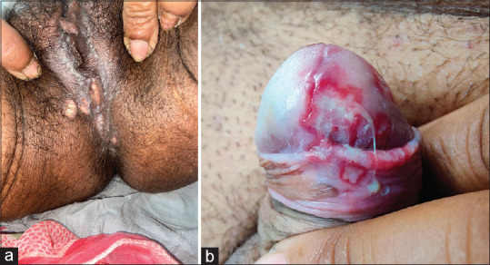 Sexually transmitted infections in the elderly: A growing concern in geriatric care.