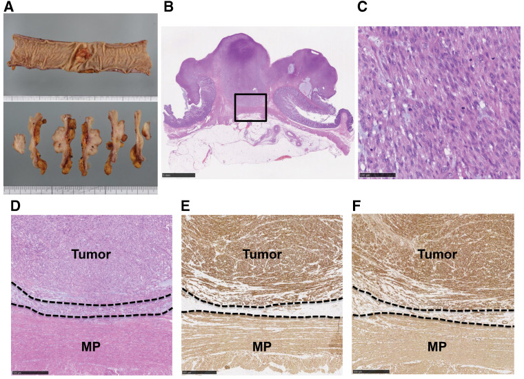 A Case of Colon Leiomyosarcoma Arising from the Muscularis Mucosae: A Case Report and Literature Review.