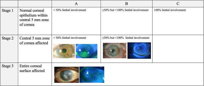 Diagnostic approach to limbal stem cell deficiency.