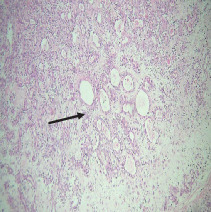 Intraoral Pleomorphic Adenoma of the Minor Salivary Glands: A Case Series of 10 Cases With Emphasis on Histopathological Features.