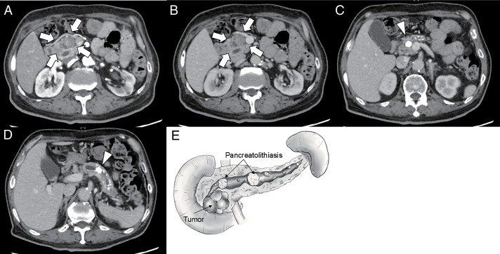 Longitudinal Pancreatojejunostomy for Pancreaticodigestive Reconstruction in the Resection of Pancreatic Head Malignancy with Chronic Pancreatitis: A Case Report.