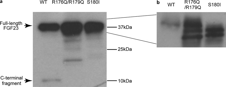 A Novel Pathogenic Variant in Fibroblast Growth Factor 23 outside the Furin-Recognizing RXXR Motif in an Autosomal Dominant Hypophosphatemic Rickets Patient.