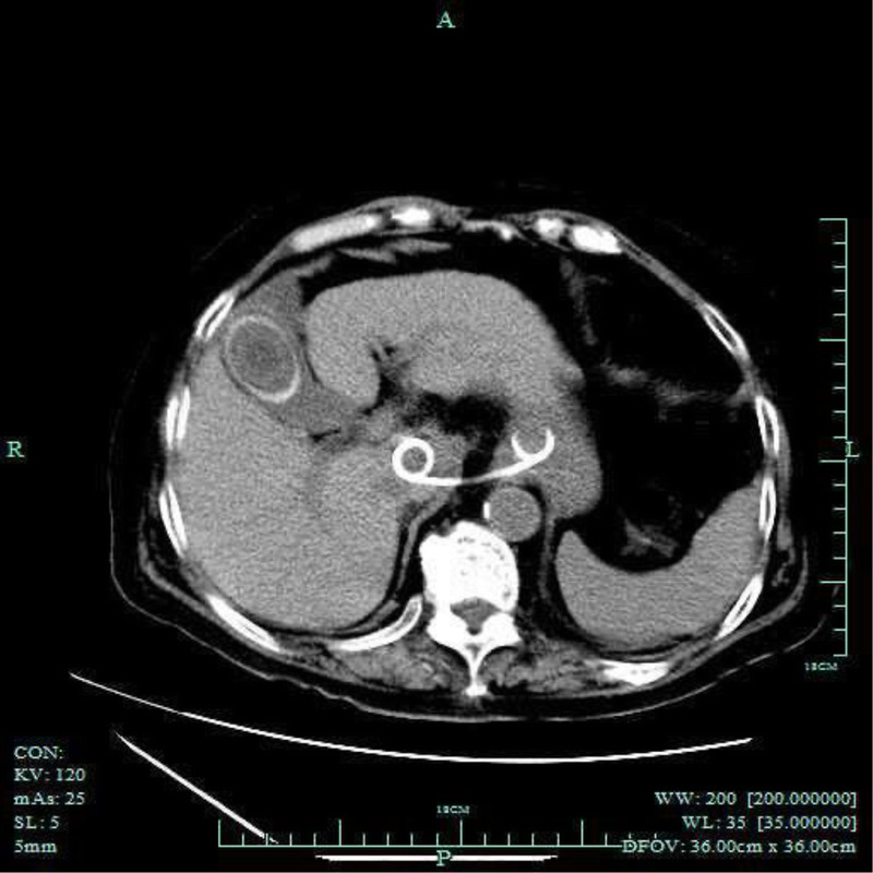 EUS-guided drainage of multidrug-resistant enterococcal caudate lobe abscess inaccessible with percutaneous approach (with video).
