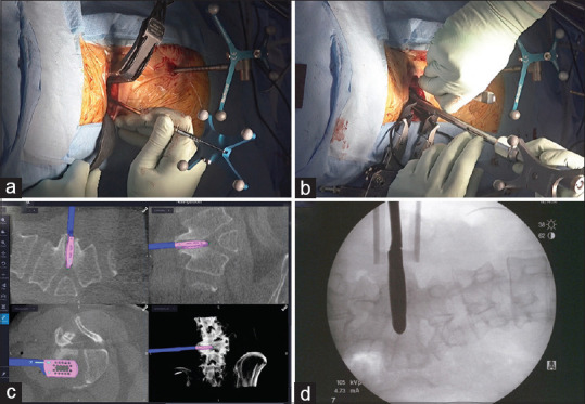 Oblique lateral interbody fusion with O-arm navigation for lumbar hemivertebra in an adult: A technical case report.
