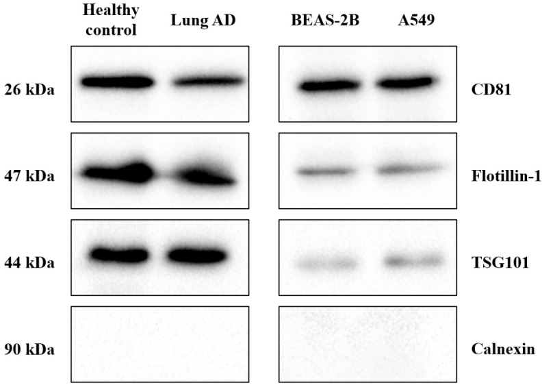 Extracellular vesicle-associated epidermal growth factor receptor as a potential liquid biopsy biomarker in lung adenocarcinoma: a case-control study.
