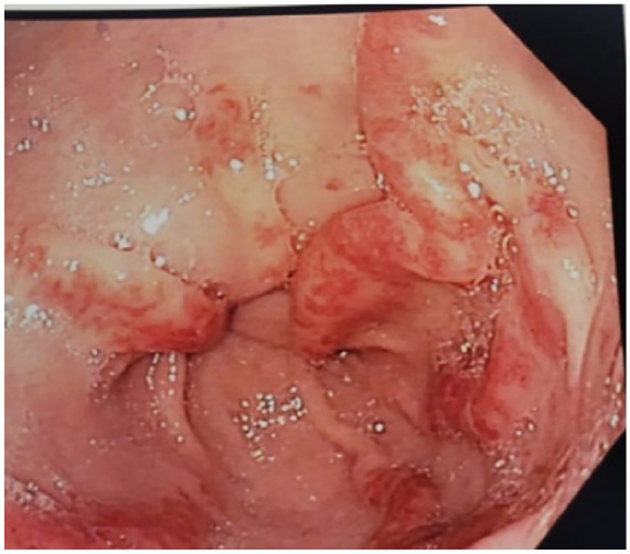 A Case Report and Literature Review on Systemic Sclerosis Manifesting as Melena and Hematochezia.