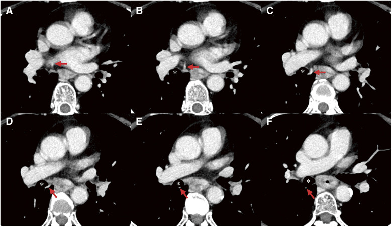 Intraoperative Fluorescent Imaging with Indocyanine Green during Thoracoscopic Esophagectomy with Subcarinal Lymph Node Dissection for Esophageal Cancer with a Right Superior Pulmonary Vein Anomaly: A Case Report and Literature Review.