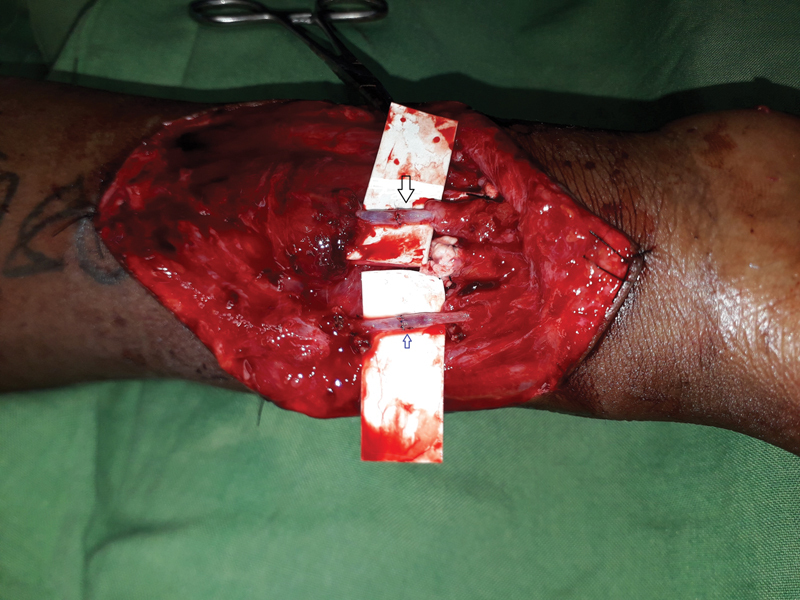 Incidental Finding of an Injured Anomalous Artery in the Forearm: To Repair or Not.