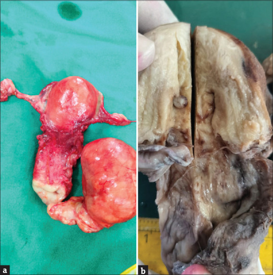 Silent Intruders: A Case Report of Concurrent Atypical Endometrial Polyp with Cervical Intraepithelial Neoplasia.