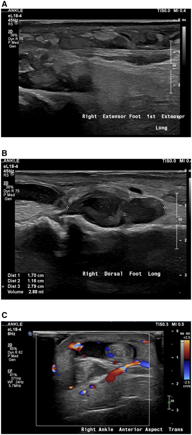 Rare complications of ERCP-pancreatitis, panniculitis, and polyarthritis syndromeand multifocal osteomyelitis.