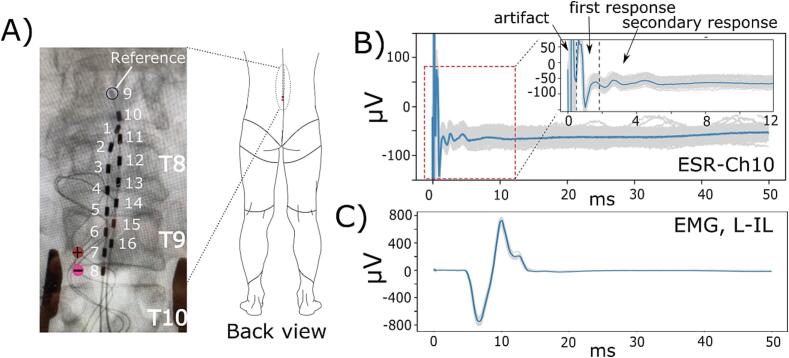 Case report: Potential physiological sources of the late response in epidural spinal recordings induced by spinal cord stimulation during intraoperative neuromonitoring