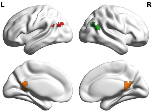 No effect of apolipoprotein E polymorphism on MRI brain activity during movie watching.