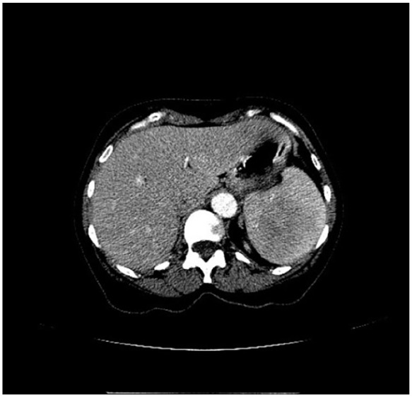 Application of Nuclear Medicine Liver-Spleen Scan for Evaluation of Littoral Cell Angioma of the Spleen: A Case Report.