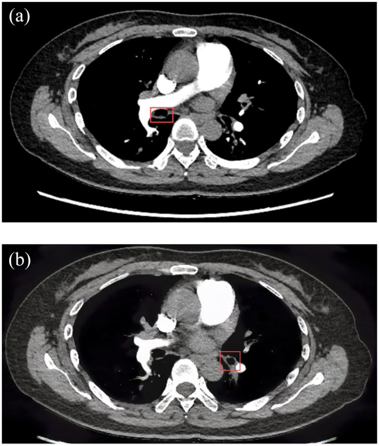 Tracheobronchial amyloidosis with Sjögren's syndrome: a case report.