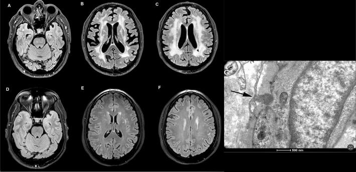 Novel NOTCH3 mutation c.1564 T > A (p.Cys522Ser) presenting with early-onset Parkinsonism and white matter lesions