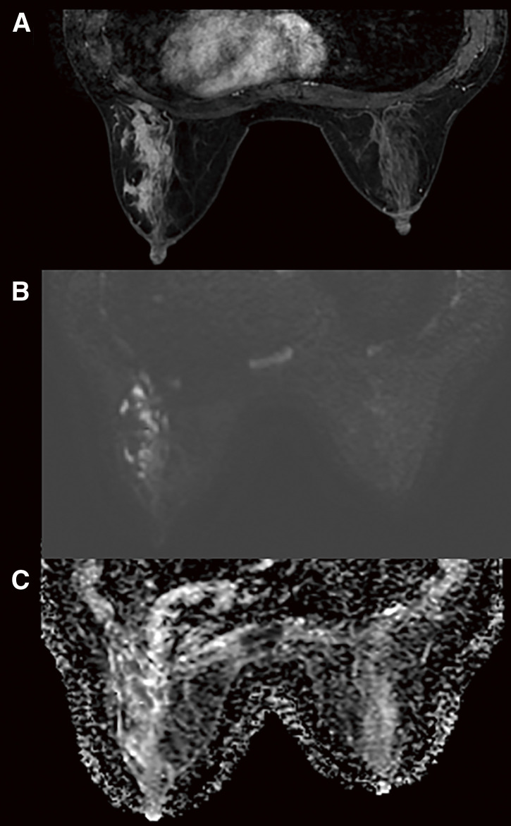 A Case of Cystic Neutrophilic Granulomatous Mastitis in Which <i>Mycobacteroides abscessus</i> Was Detected.