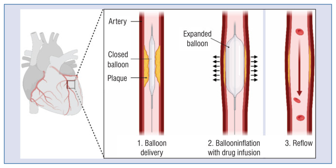Drug-coated balloons in percutaneous coronary interventions: existing evidence and emerging hopes.