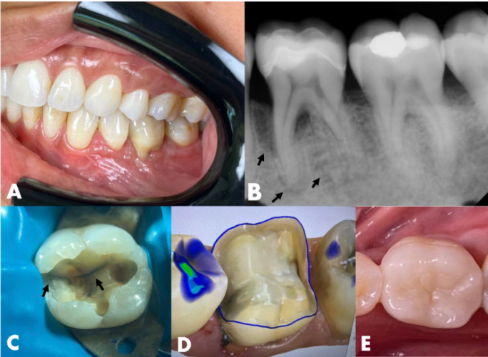 Efficacy of Biodentine as an Intraorifice Barrier in a Cracked Tooth with Endo-periodontal Lesions: A Case Report.