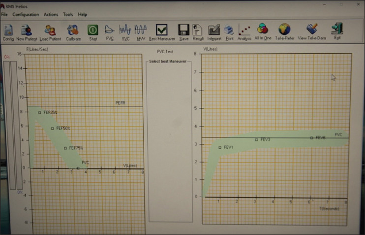 Assessment of lung function in partially edentulous patients using spirometry: A cross-sectional study.