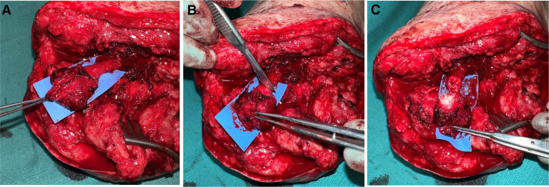 Regenerative Peripheral Nerve Interface Surgery to Treat Chronic Postamputation Pain: A Prospective Study in Major Lower Limb Amputation Patients.