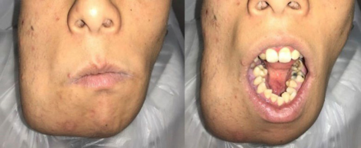 Oral Health and Dental Management Strategies in Noonan Syndrome: A Case Report.