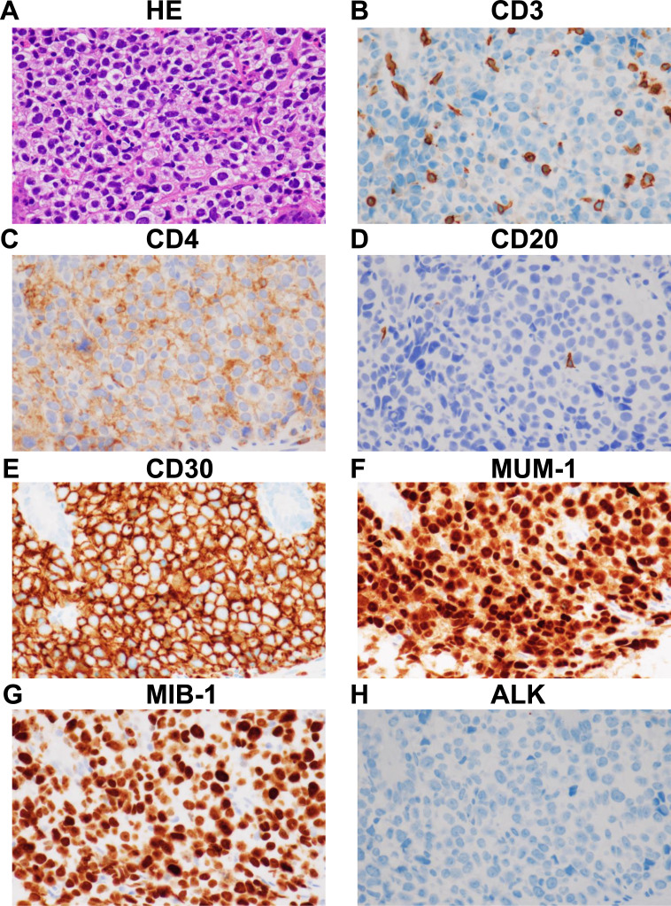 ALK-negative anaplastic large cell lymphoma with TP53 mutation developing during the administration of baricitinib for atopic dermatitis - A case report.
