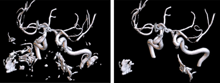 Patch-Wise Deep Learning Method for Intracranial Stenosis and Aneurysm Detection-the Tromsø Study.