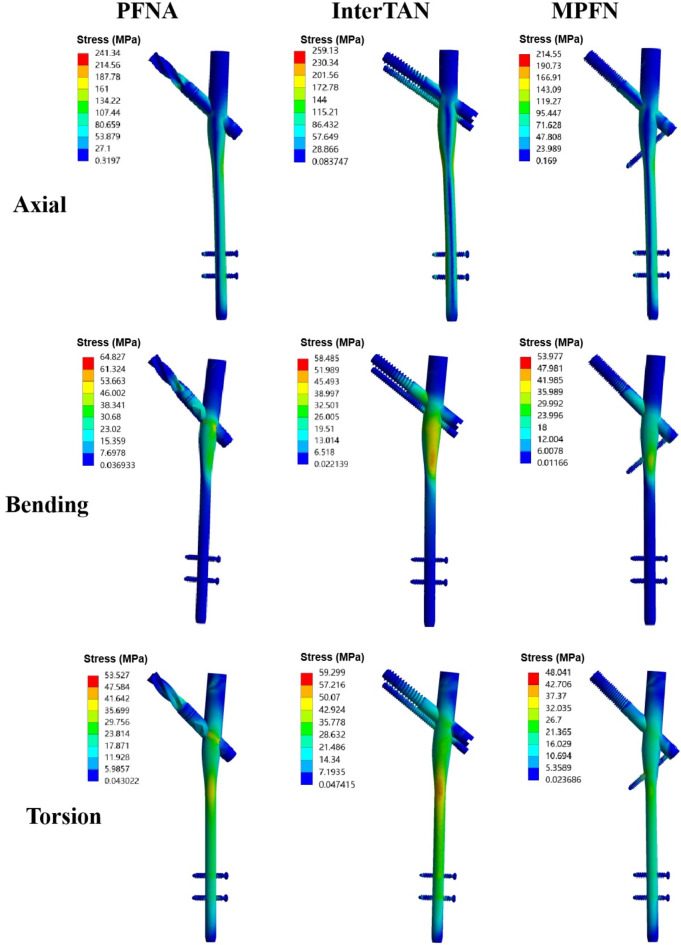 Biomechanical evaluation of the modified proximal femoral nail for the treatment of reverse obliquity intertrochanteric fractures.