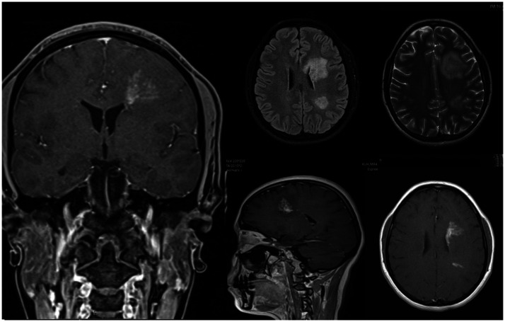 Diagnostic challenges in SLIPPERS syndrome: Case report.