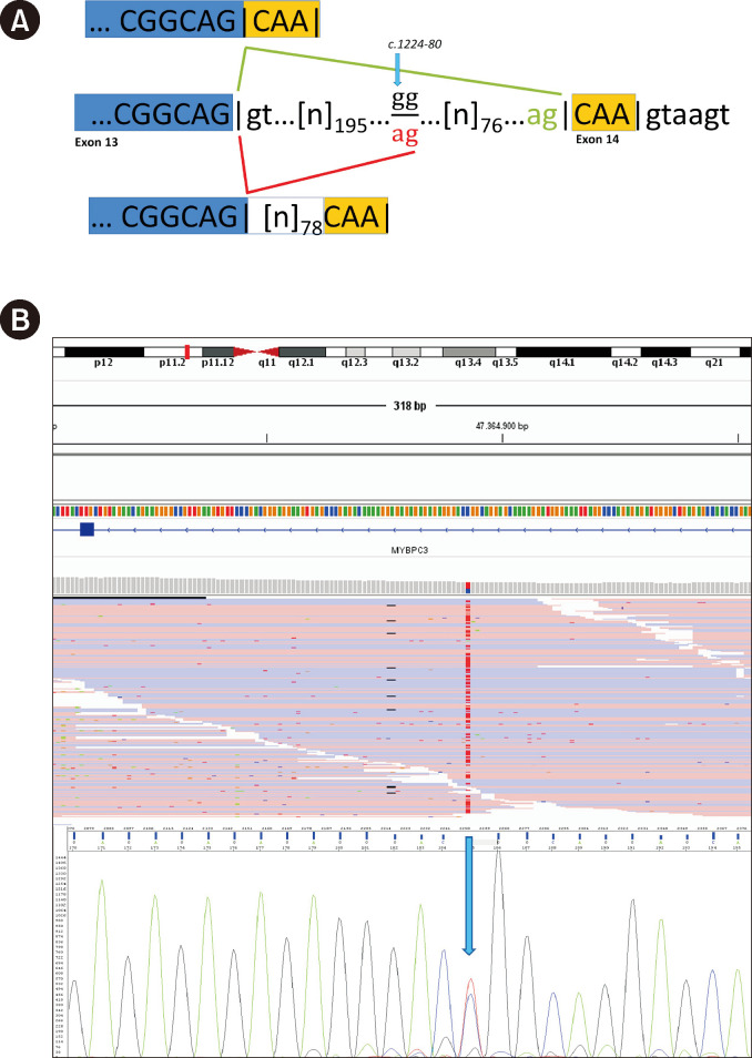 Reanalysis of Next-generation Sequencing Data in Patients With Hypertrophic Cardiomyopathy: Contribution of Spliceogenic <i>MYBPC3</i> Variants in an Italian Cohort.