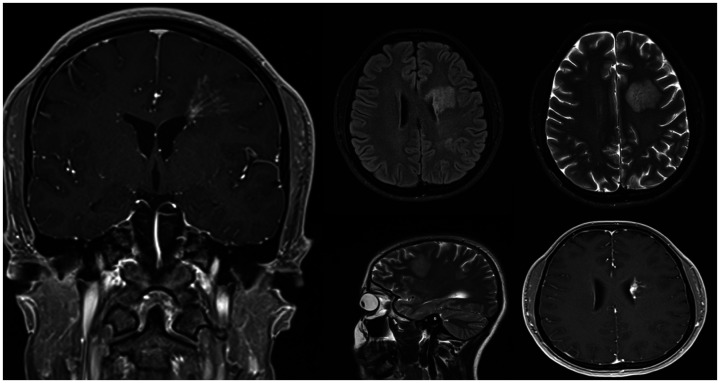Diagnostic challenges in SLIPPERS syndrome: Case report.