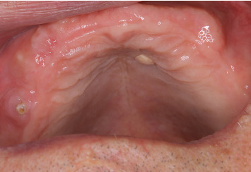 A Case of an Oral Elastofibromatous Lesion: A Clinicopathological Analysis With a Literature Review.