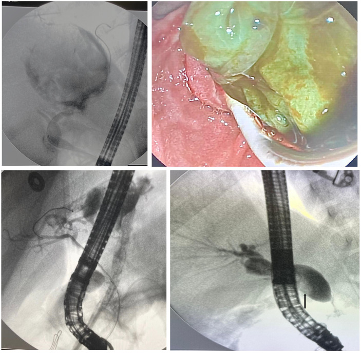 Endoscopic Retrograde Cholangiopancreatography in Pediatric Population: A Decade-Long Experience from 2 Tertiary Centers.