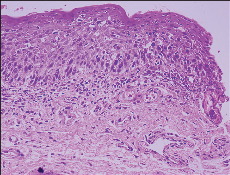 A conundrum of recurrent pustular lesions of the glans.
