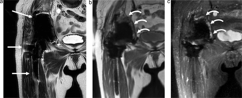 Evaluating Hip Periprosthetic Joint Infection with Metal-artifact-reduction MR Imaging.