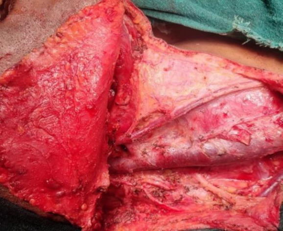 Internal Jugular Vein Duplication: A series of Seven Cases and Review of Literature.